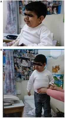 Extreme Short Stature and Severe Neurological Impairment in a 17-Year-Old Male With Untreated Combined Pituitary Hormone Deficiency Due to POU1F1 Mutation
